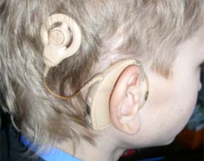 Кохлеарная имплантация помогает глухим детям