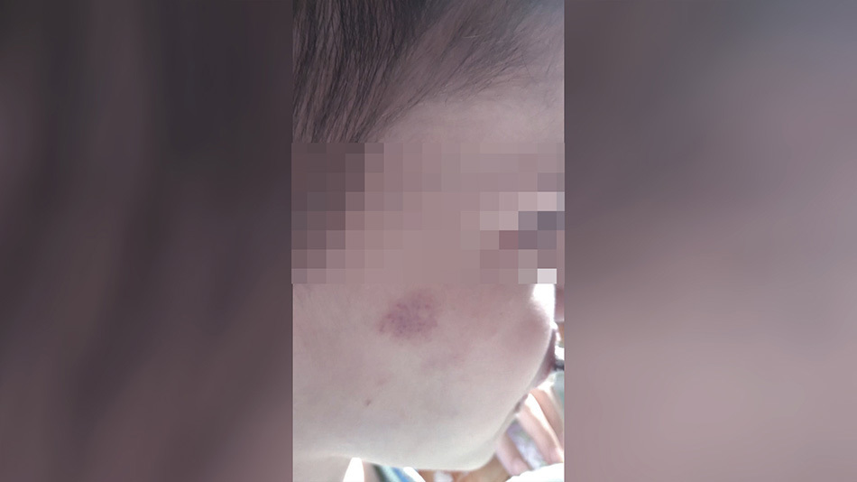 Глухой мальчик получил травмы в школе-интернате в Симферополе